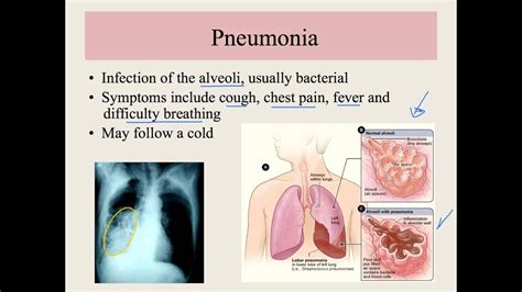 Unit 13 2 Respiratory System Disorders Youtube