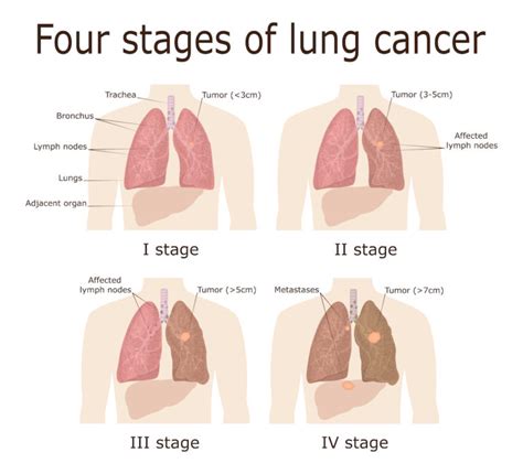 Lung Cancer Symptoms Risk Factors Diagnosis And Treatment Saint