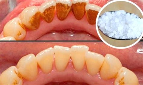 This Can Even Whiten Extremely Yellow Teeth And Remove That Nasty Plague