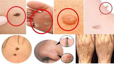 moles warts and skin tags removal review should you buy it or not