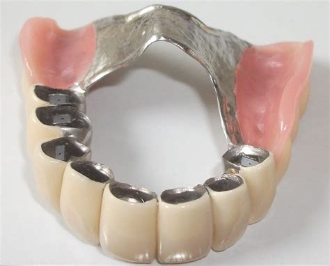 fixedremovable prosthetics dental dictionarycom