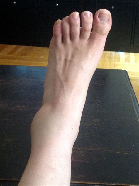 sprained  ankle