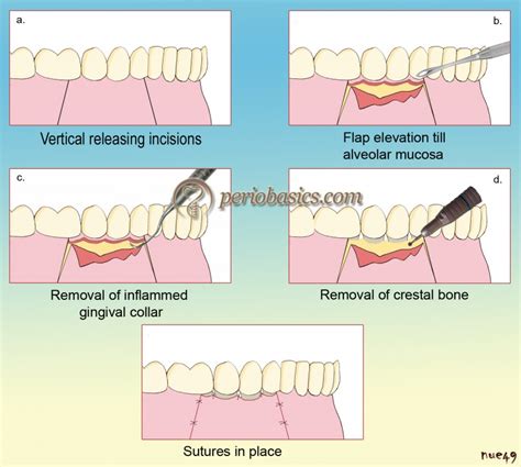 history  surgical periodontal pocket therapy  osseous resective