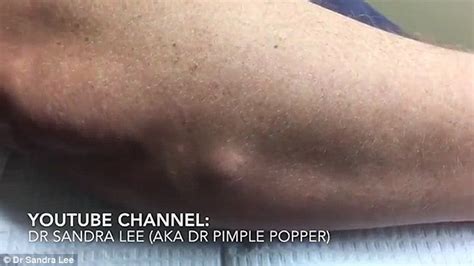 yellow fatty lump bursts    mans arm   doctor cuts     scalpel daily mail