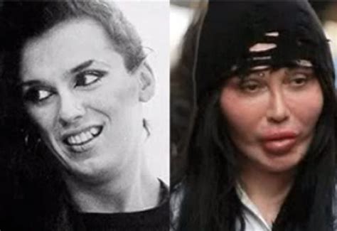 17 celebrity before and after plastic surgery disasters business insider