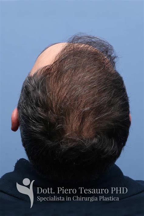 La tonsura ecclesiastica consiste essenzialmente nel taglio di cinque ciocche di capelli, come simbolica forma di rinuncia al mondo da parte dell'aspirante chierico, e come segno di … Trapianto capelli calvizie maggiori - Tecnica STRIP - Milano