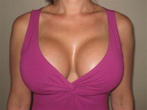 1000cc Saline Breast Implant Photos Xl Breast