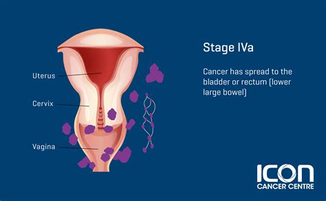 cervical cancer — trung tâm ung bướu icon singapore