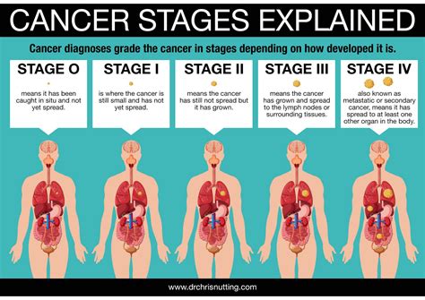 diagnosing head  neck cancer oracle cancer trust