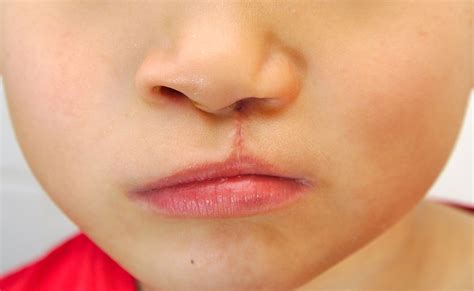 cleft lip  cleft palate ent health
