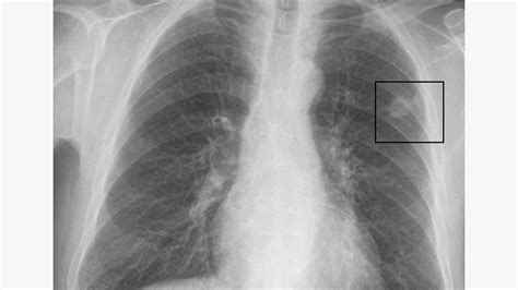 lung nodule size chart hot sex picture