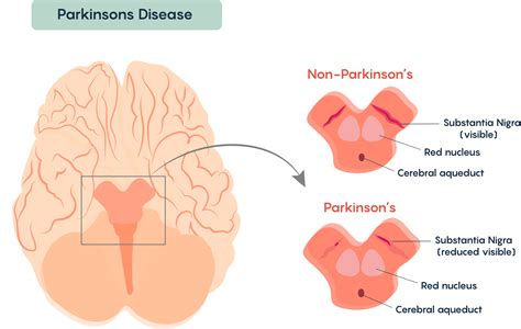 chronic neurodegenerative diseases neuroscience canadian st