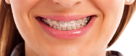 Discomfort From Getting Braces Tightened Frost Orthodontist