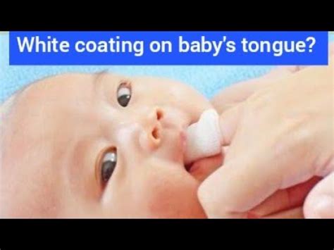 white coating  babys tongue thrush  milk residue   treat