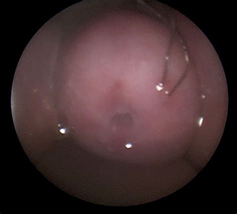 Perforation Of The Cervix By Threads From An Intrauterine System The Bmj