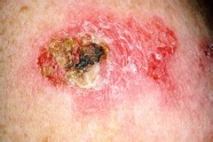scaly red skin spot image details nci visuals