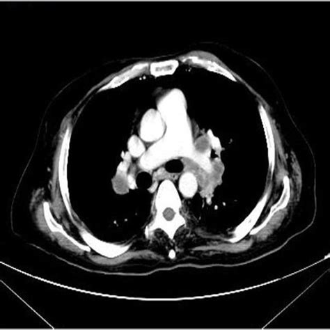 Ct Scan Of The Chest With Iv Contrast Shows Bilateral Hilar And