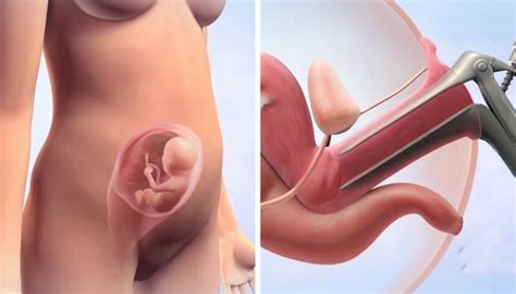 intrauterine insemination iui for infertility treatment