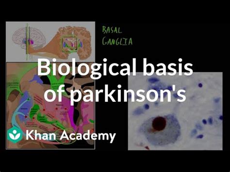 biological basis  parkinsons disease video khan academy
