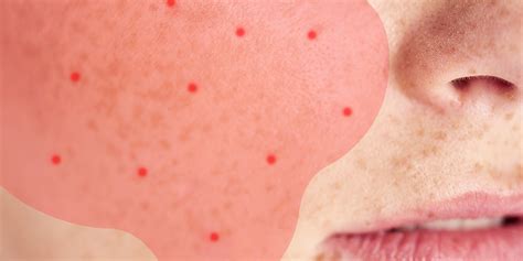 how to tell if your acne might actually be rosacea self