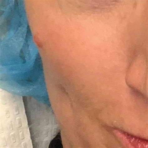 woman shares warning  mark  face diagnosed  cancerous tumor