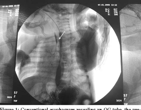 Figure 1 From Management Of H Type Tracheoesophageal Fistula In