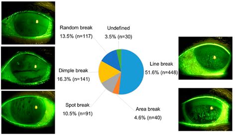 diagnostics  full text characteristics  utility  fluorescein breakup patterns