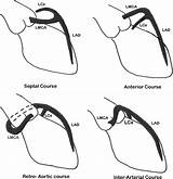 Coronary Artery Anomalies Classification Heartasia Bmj sketch template