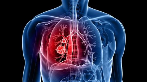 How To Ease The Pain Of Lung Cancer Everyday Health