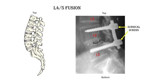 fusion indications complications treatments