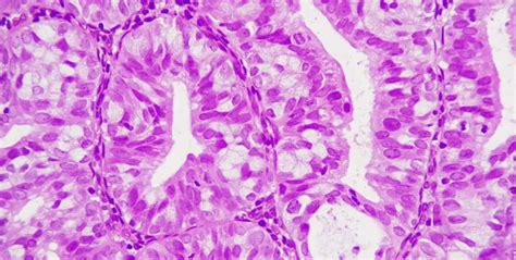 adenocarcinoma de cérvix relacionado ao hpv tipo usual citolab