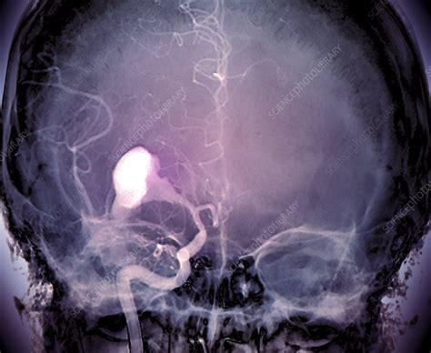 brain haemorrhage x ray stock image c013 3032 science