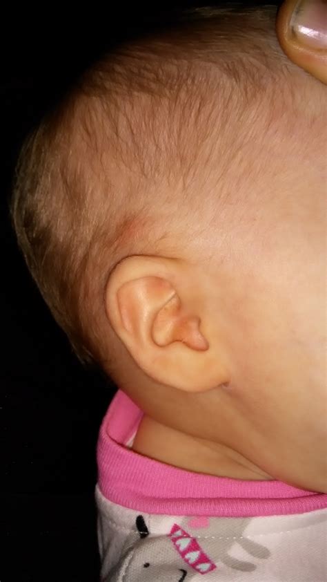 lump  daughters  ear october  babies forums