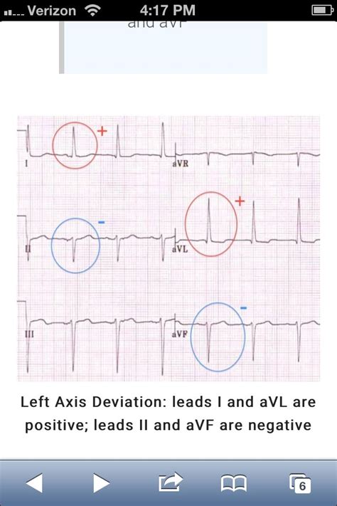 left axis   lead httplifeinthefastlanecomecg librarybasicsleft axis deviation