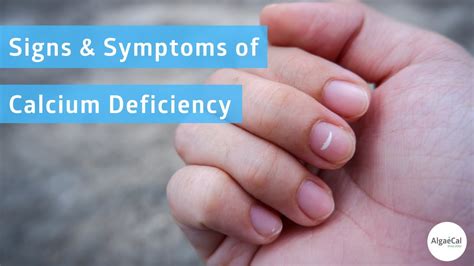 calcium deficiency  signs symptoms