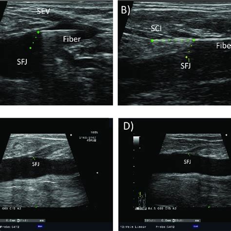 cranial tributary ablation   saphenofemoral junction  laser crossectomy