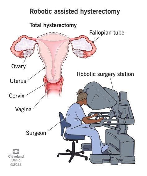 unveiled benefits  hysterectomy ultimate guide