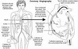 Coronary Angiography Catheter sketch template