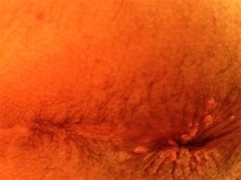 bumps near anal area and pregnant tubezzz porn photos