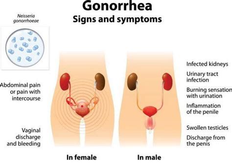 Gonorrhea Clinical Presentation Diagnosis And Treatment Sexually