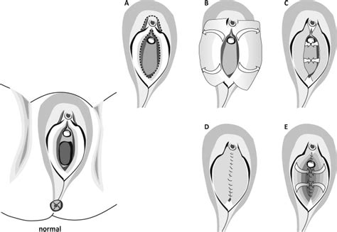 vaginal reconstruction with labia minora after an anterior exenteration