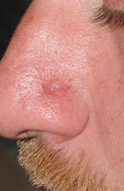 syphilis on the face in primary care a rare sign of an