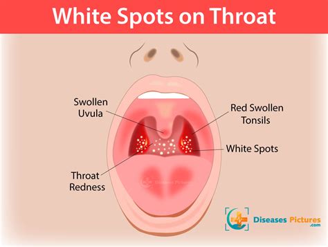 white spots  throat tonsils  symptoms treatments healthmd