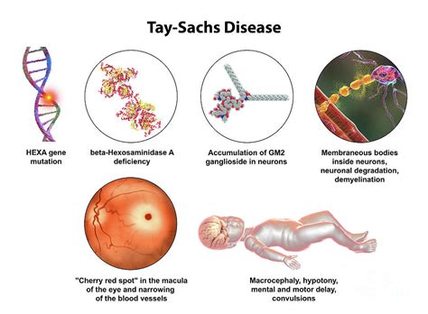Tay Sachs Disease Photograph By Kateryna Kon Science Photo Library
