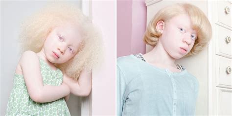 these 12 photos of people with albinism will take your