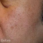 caring  beauty blogspotcom   brown spots  face skin