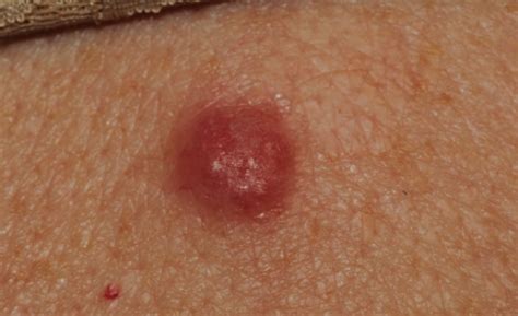 year  female  persistent red bump    doctors channel