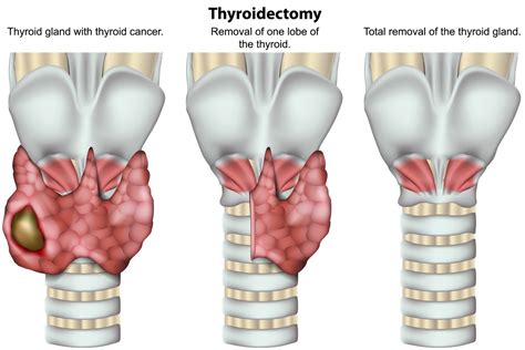 woman     thyroid page   health