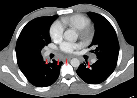 Ct Chest Showing Extensive Hilar And Mediastinal Adenopathy Red Arrow