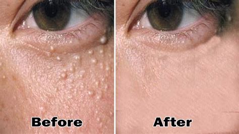 ways   rid  milk spots milia forehead acne bumps  eyes pimples  face